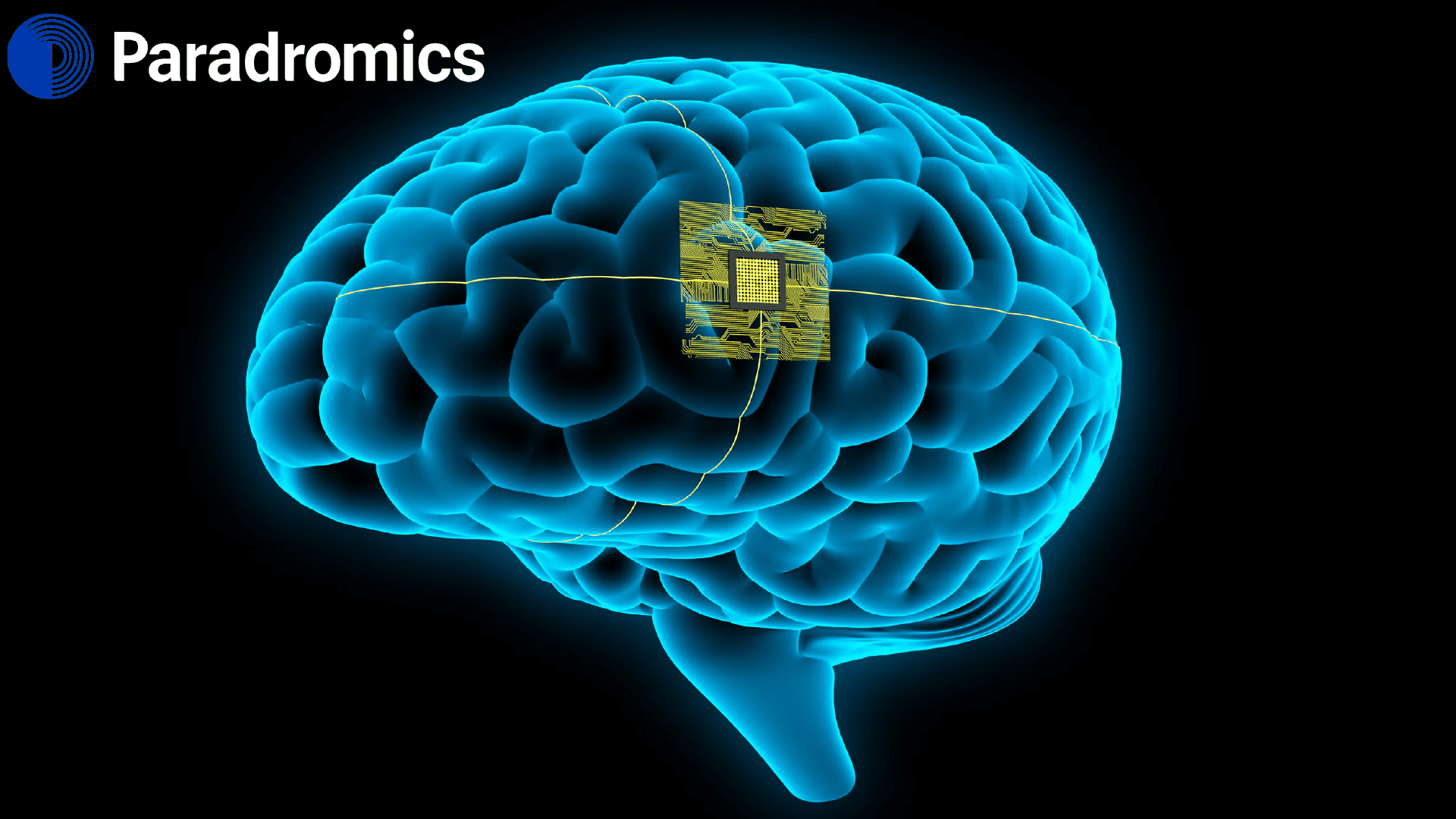 Paradromics Tests Brain Implant in Human Successfully